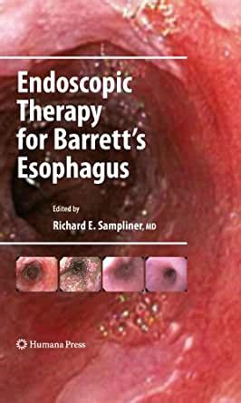 Amazon Com Endoscopic Therapy For Barrett S Esophagus Clinical