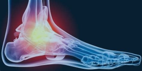 Foot Drop Symptoms And Treatments Legacy Spine And Neurological
