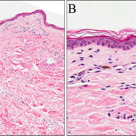 Pdf Neuropathic Itch Of The Back A Case Of Notalgia Paresthetica