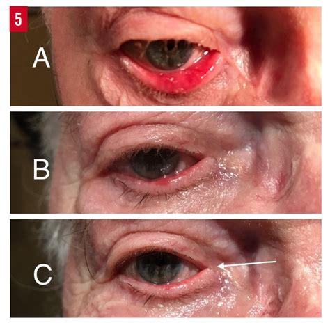 Ectropion Classification Diagnosis And Management Consultant360