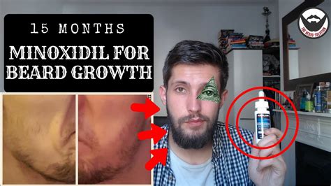 A common question concerns how long does minoxidil take to work on your beard. Minoxidil Beard Growth Results | 15 Months on Minoxidil for beard growth | #TheJourneyContinues ...