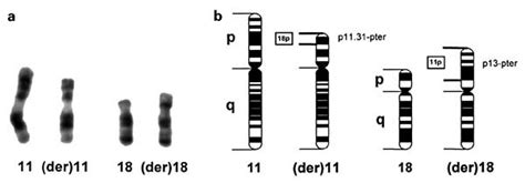 Chromosome 1118 Translocation In The Patient A Gtg Banded Pairs Of