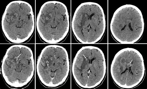 Primary Cns Lymphoma Radiology Cases