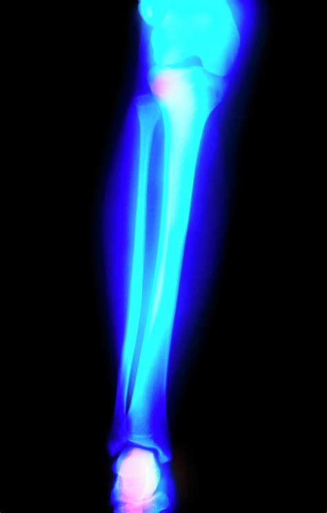 Coloured X Ray Of Lower Leg In Young Adult Photograph By Science Photo