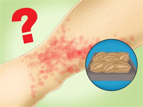 Most times, they are harmless, clear up within in a day and don't leave. 3 Ways to Prevent Hives - wikiHow