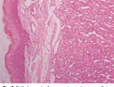 Figure 1 From Capillary Hemangioma In Maxillary Anterior Region A Case