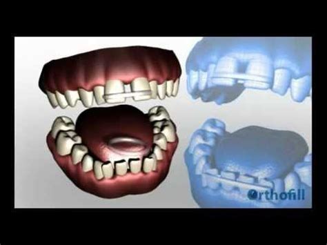 Do you have gaps between your teeth? Fix gap in teeth permanently in just 1 month for only $27 ...