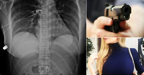 Woman S Breast Implants Saved Her Life By Deflecting A Bullet From A