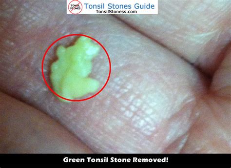Best Tonsil Stones Images And Videos 2022