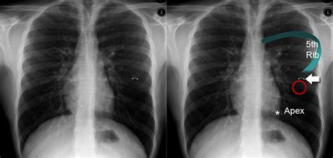 Chest X Ray Devices And Artifacts Normal Reference