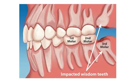 What Is A Wisdom Tooth The Tennessee Tribune