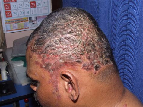 Mild irritation if you're mildly irritated by ppd, you may find that your scalp, neck, forehead, ears or eyelids become irritated and inflamed after using hair dye. Do hair dyes cause scalp psoriasis in man?
