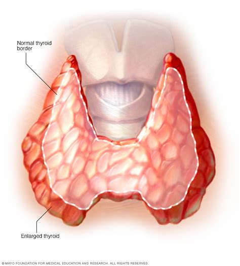 Goiter Symptoms And Causes Mayo Clinic