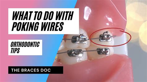 What To Do With Braces Poking Wire Braces Emergency Braces Tips Youtube