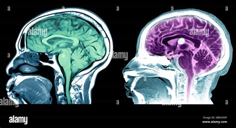 Mri Of Normal Brain And Colloid Cyst Stock Photo Alamy