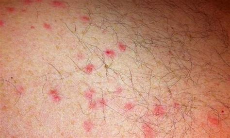 Scabies Rash Look Like And Causes7