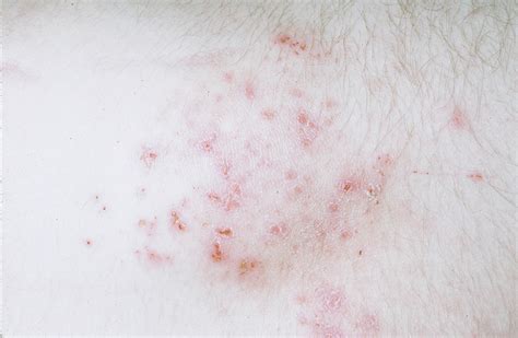 Dermatitis Herpetiformis Lægehåndbogen På Sundheddk