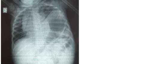 Secondary Spontaneous Rupture Of The Diaphragm In A Child After Blunt
