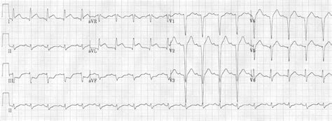 Anterior Stemi Ekg