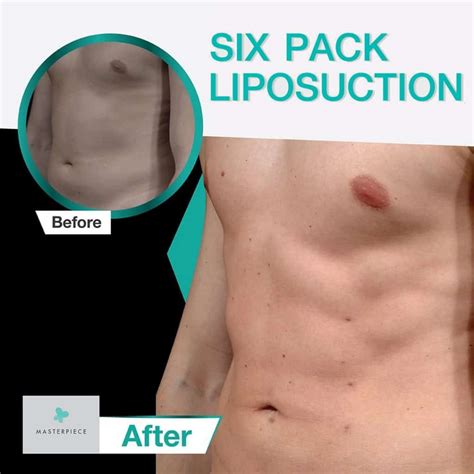 Six Pack Abs Vaser Liposuction Masterpiece Hospital