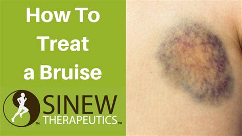 How To Treat A Bruise And Speed Recovery Youtube