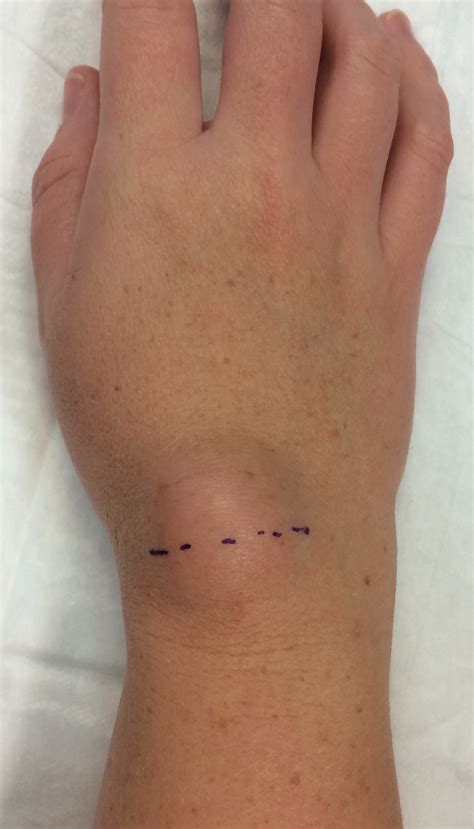 Wrist Ganglion — Dr Mark Hile Wrist And Hand Specialist Surgeon Sydney