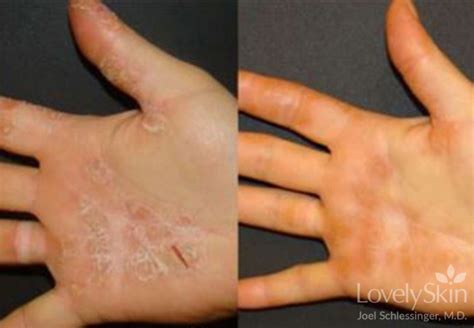 Eczema Before And After Photos Skin Specialists Pc
