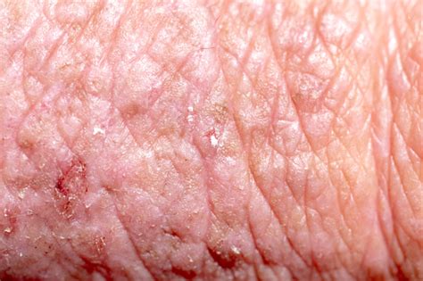 Atopic Dermatitis Stock Photo Download Image Now Istock