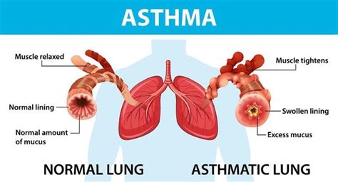 Asthma Diagram With Normal Lung And Asthmatic Lung 3274462 Vector Art