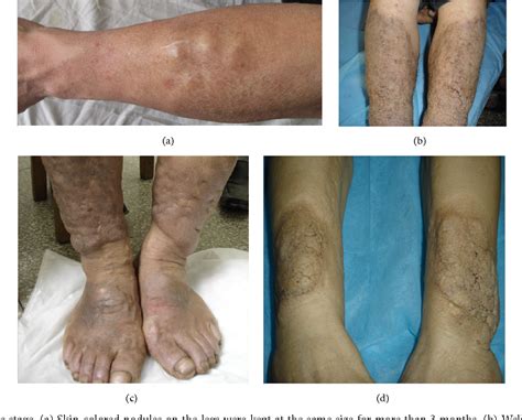 Figure 3 From Morphological Diversity Of Pretibial Myxedema And Its