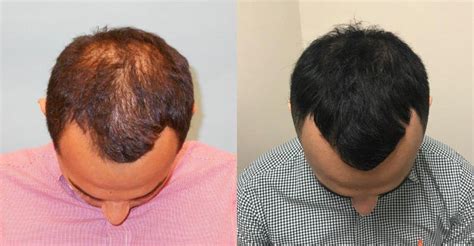 Clinical and histomorphometric evaluation marco k., marazzi m., luisa torre m. ACell + PRP Hair Loss Therapy Case Study - News - McGrath ...