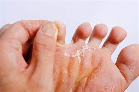 Fußpilz Behandlung Mit Natron