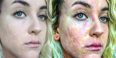 These Before And After Photos Show What Its Like To Live With Psoriasis Self