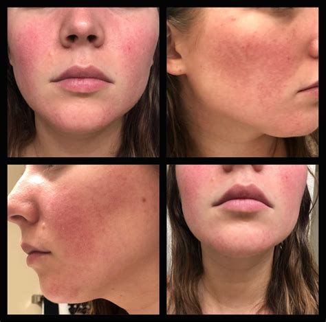 Skin Concerns I Always Have Constant Redness Only On Cheeks And Chin