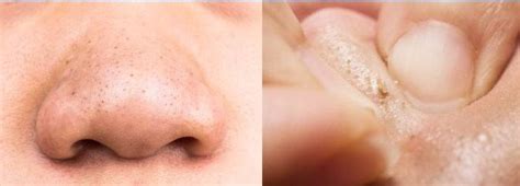 How To Remove Black Spots On The Nose Effective Home Remedies