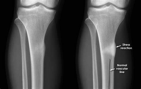 Trauma X Ray Lower Limb Gallery 1 Tibia Fractures