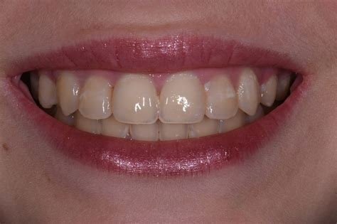 Exposed Cavities Between Front Teeth Aacd Cosmetic Dentist Auckland