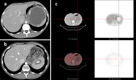 A Ct Scan Of The Abdomen Showing An 11 Cm Unilocular Splenic Abscess