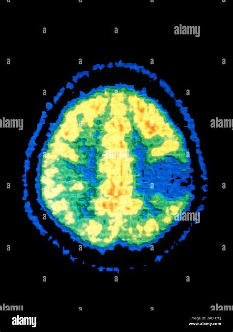 Astrocytoma Brain Tumour Coloured Positron Emission Tomography Pet