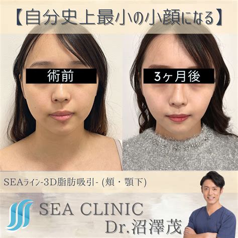自分史上最少の小顔になる！ Sea Clinic −シークリニック 銀座― 理想を叶える小顔治療