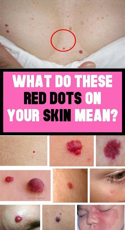 What Do These Red Dots On Your Skin Mean Natural Health Tips