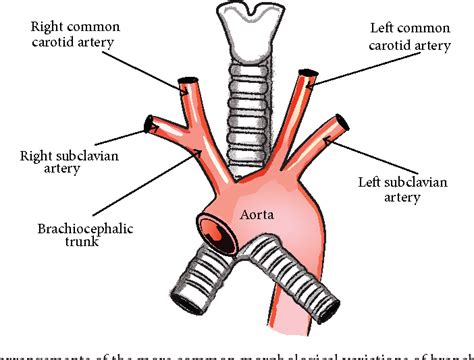 Figure 1 From The Aberrant Right Subclavian Artery Arteria Lusoria