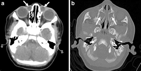 Dacryocystitis A Axial Contrast Enhanced Ct Image Of The Orbits In A