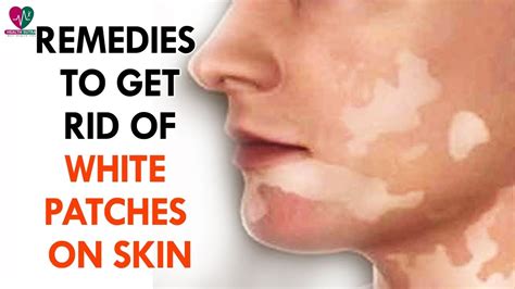 How To Get Rid Of White Patches On Skin White Patches White Skin