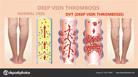 Deep Vein Thrombosis Or Blood Clots Embolus Stock Photo By ©marina113
