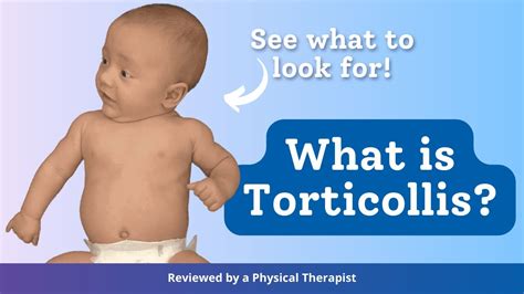 What Is Torticollis Youtube