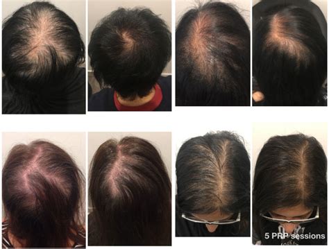 Prp Hair Loss Treatment And Skin Clinics In Melbourne And Sydney