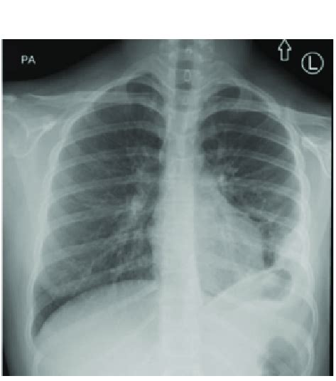 Frontal Chest Radiograph Obtained At Presentation Shows Left Lung Base Download Scientific