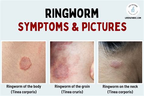 Ringworm Pictures And Symptoms What Does Ringworm Look Like