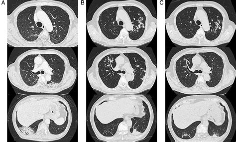 Radiological Findings A Chest Computed Tomography Ct Scan Obtained